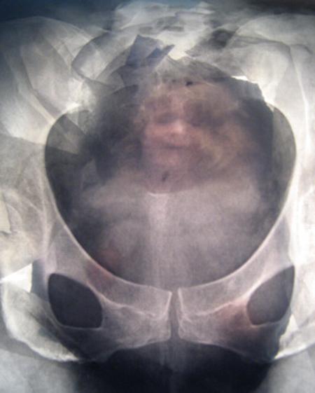 WISING UP GALLERY PATIENT SERIES #3